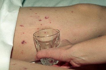 Bilde av hudblødninger. Mindre røde prikker på kroppen. Prikkene blir ikke borte når man trykker et glass mot dem.